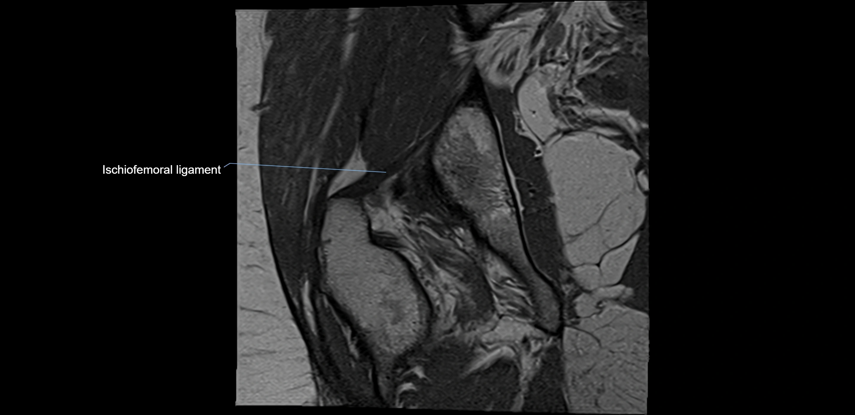 MRI Hip ligaments coronal cross sectional anatomy 3T  radiology  image-img-00001-00020.webp